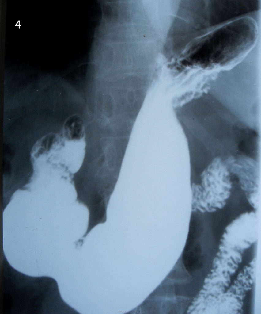 Рентгеноскопия пищевода подготовка. Скопия желудка рентген. Рентген желудка и 12 перстной кишки с контрастом. Скопия желудка с барием. Рентген исследование желудка с барием.