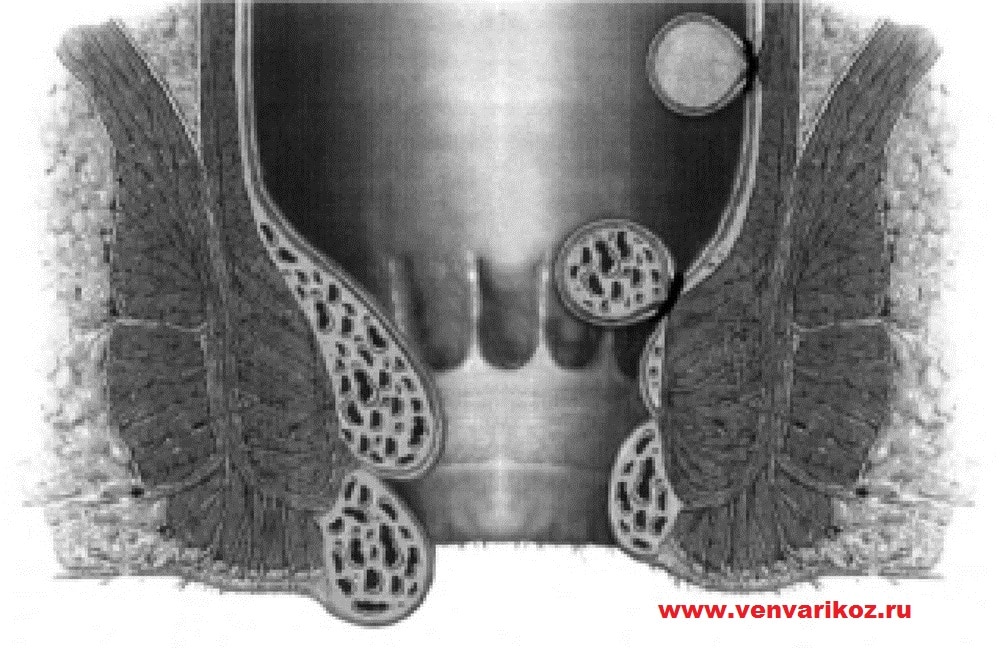 Тромбофлебит заднего прохода. Перианальный венозный тромбоз. Хронический парапроктит. Перианального абсцесс. Тромбоз наружных геморроидальных узлов.